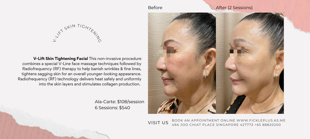 All about V-Lift RF Skin Tightening Facial