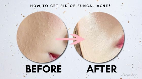 Getting rid of Tiny Bumps - Malessezia Foliculitis (Fungal Acne)!