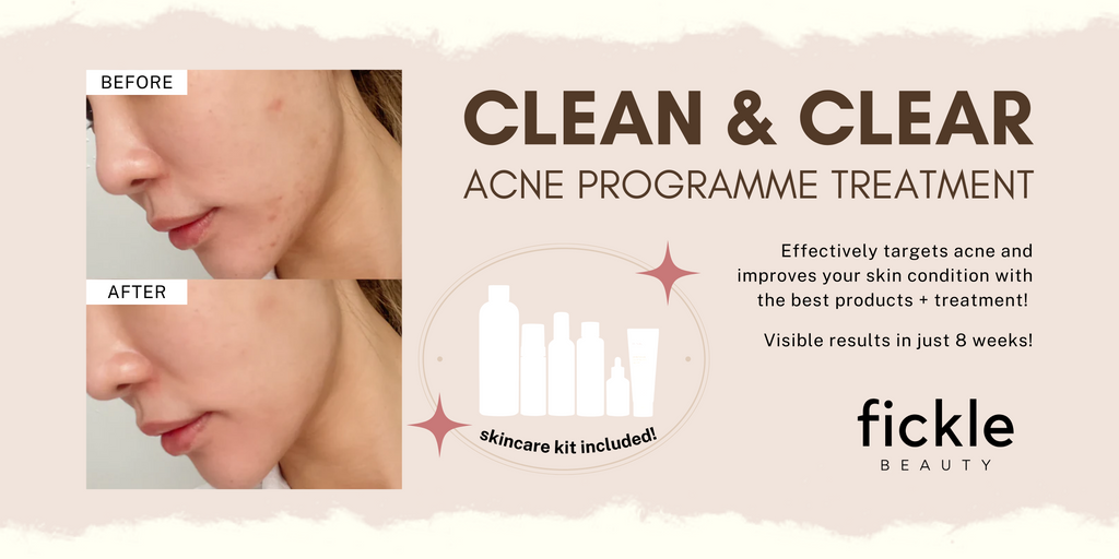 Clean & Clear Acne Programme Treatment (8 Weeks)